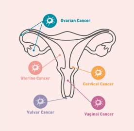 Gynaecological cancers Gynaecological cancers